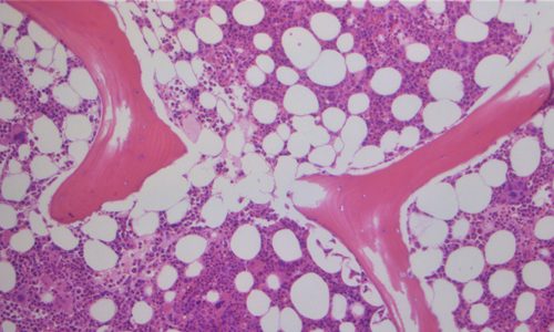 Bone Marrow Pathology