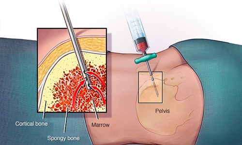 Bone Marrow Pathology(1)